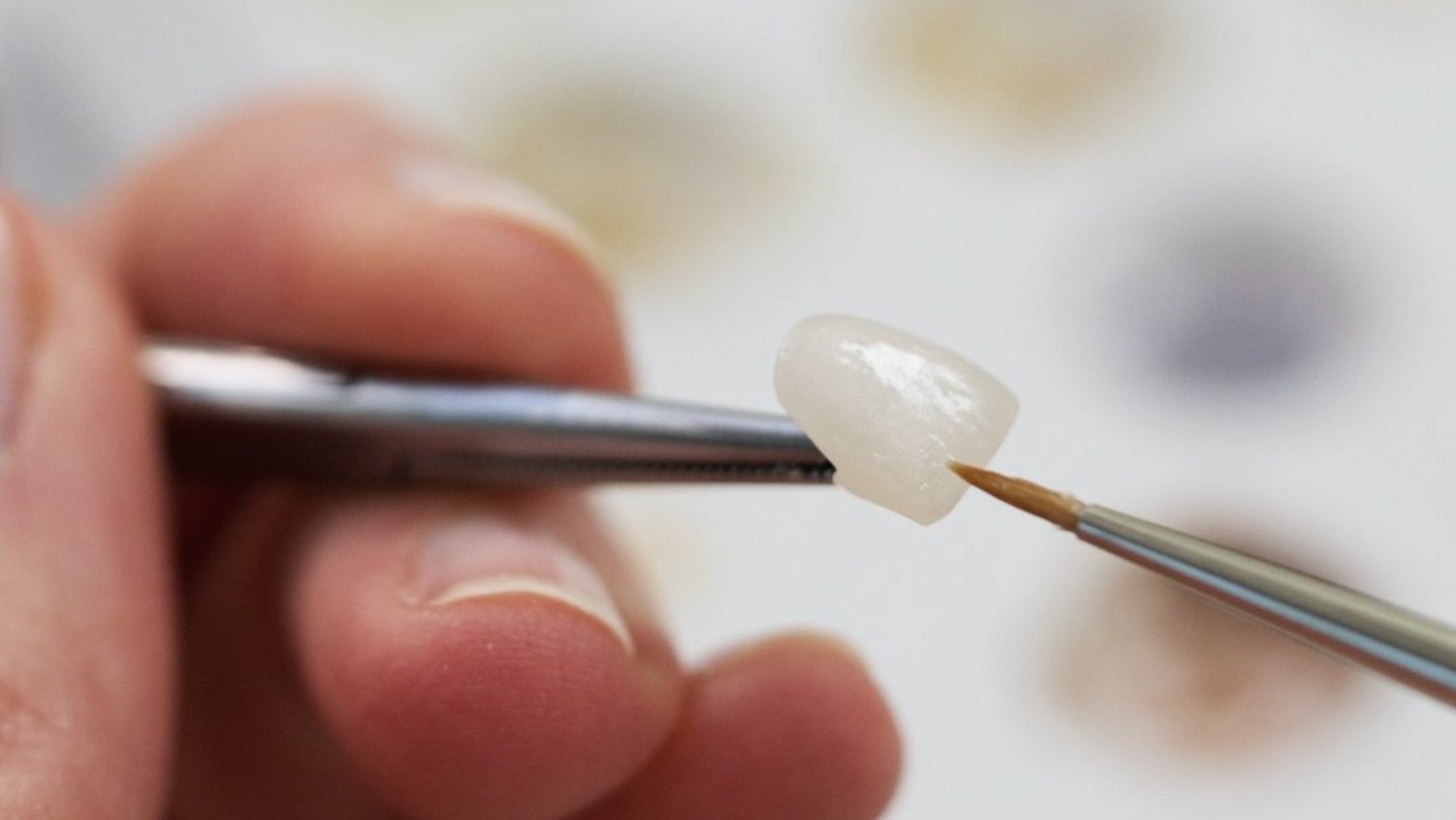 Veneers: nur Mode-Accessoire?