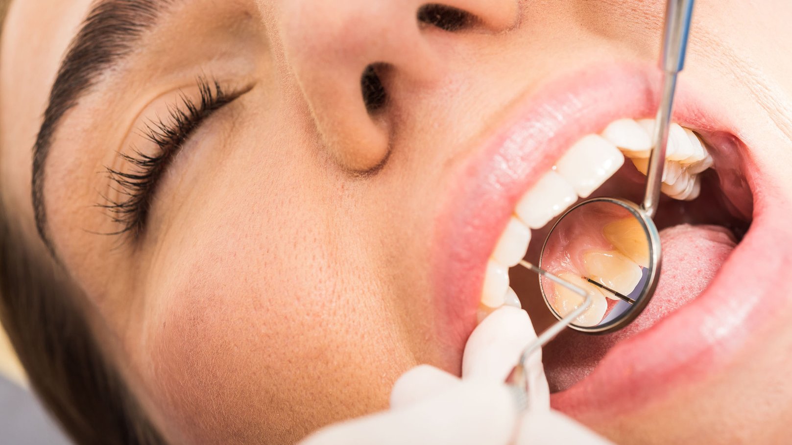 Mundgeruch Parodontitis