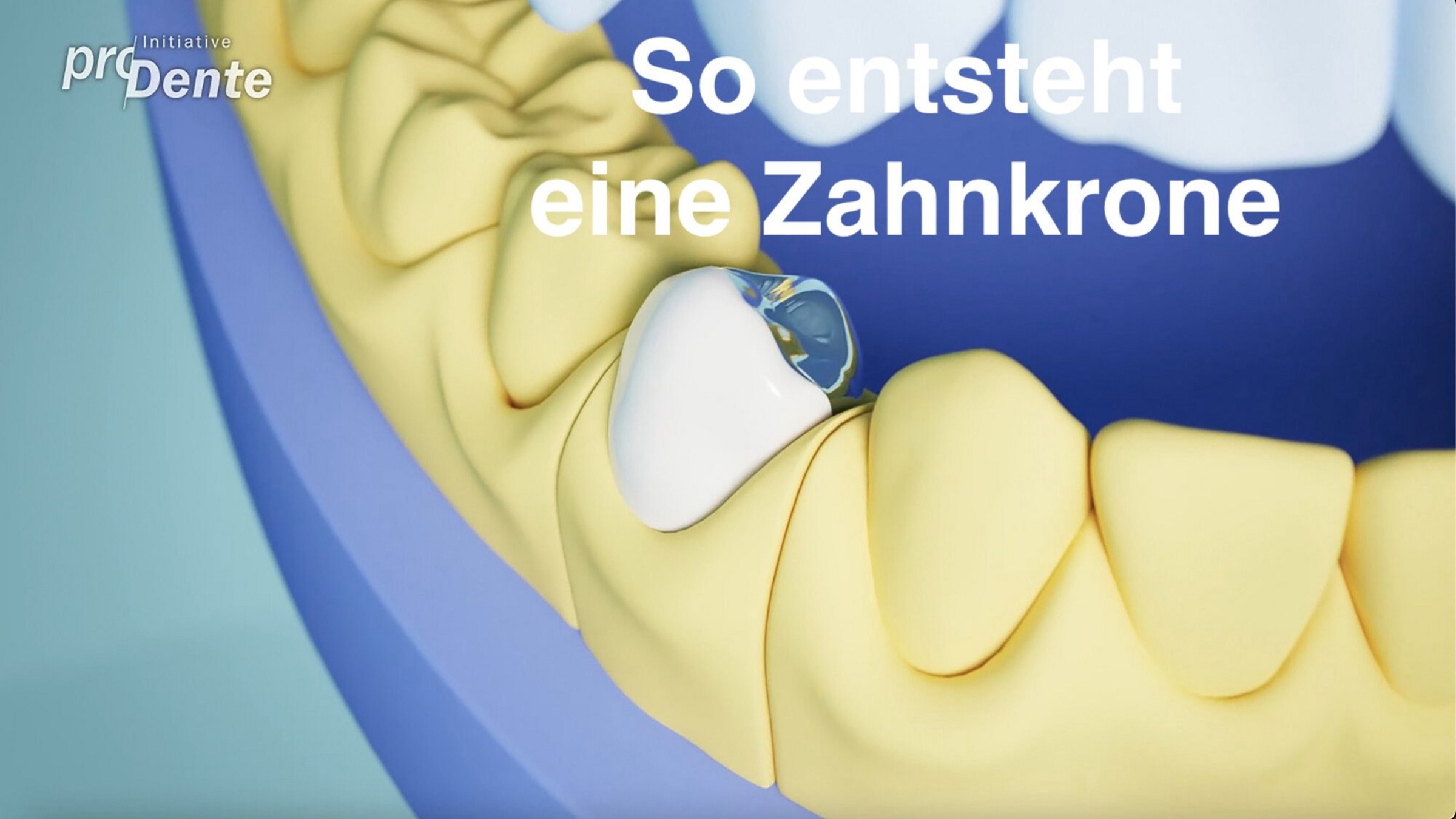 Zahnkrone Zahnkrone