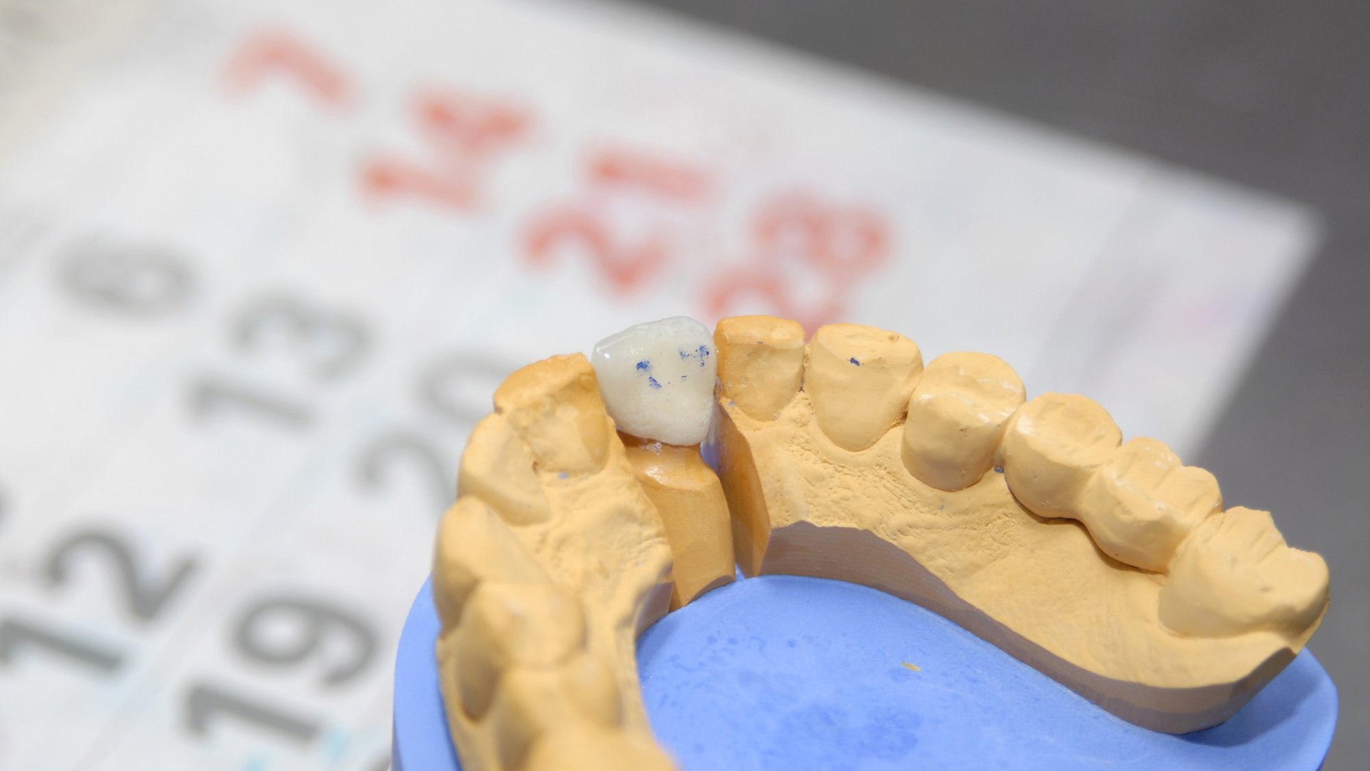 Zahnkrone Schneidezahn