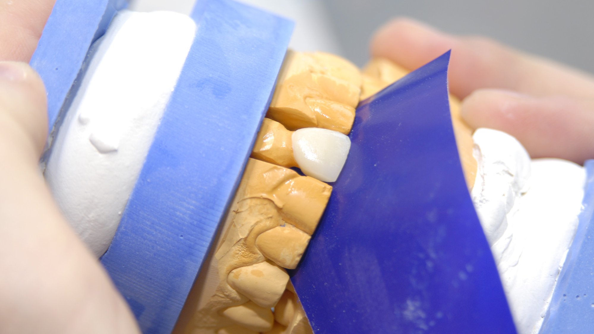 Zahnkrone Schneidezahn