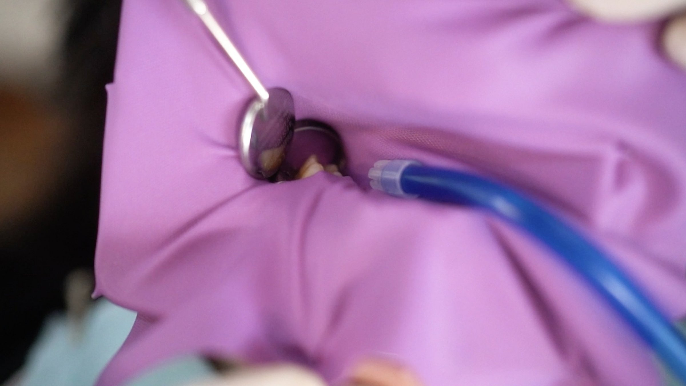 Wurzelbehandlung: Wie geht das?