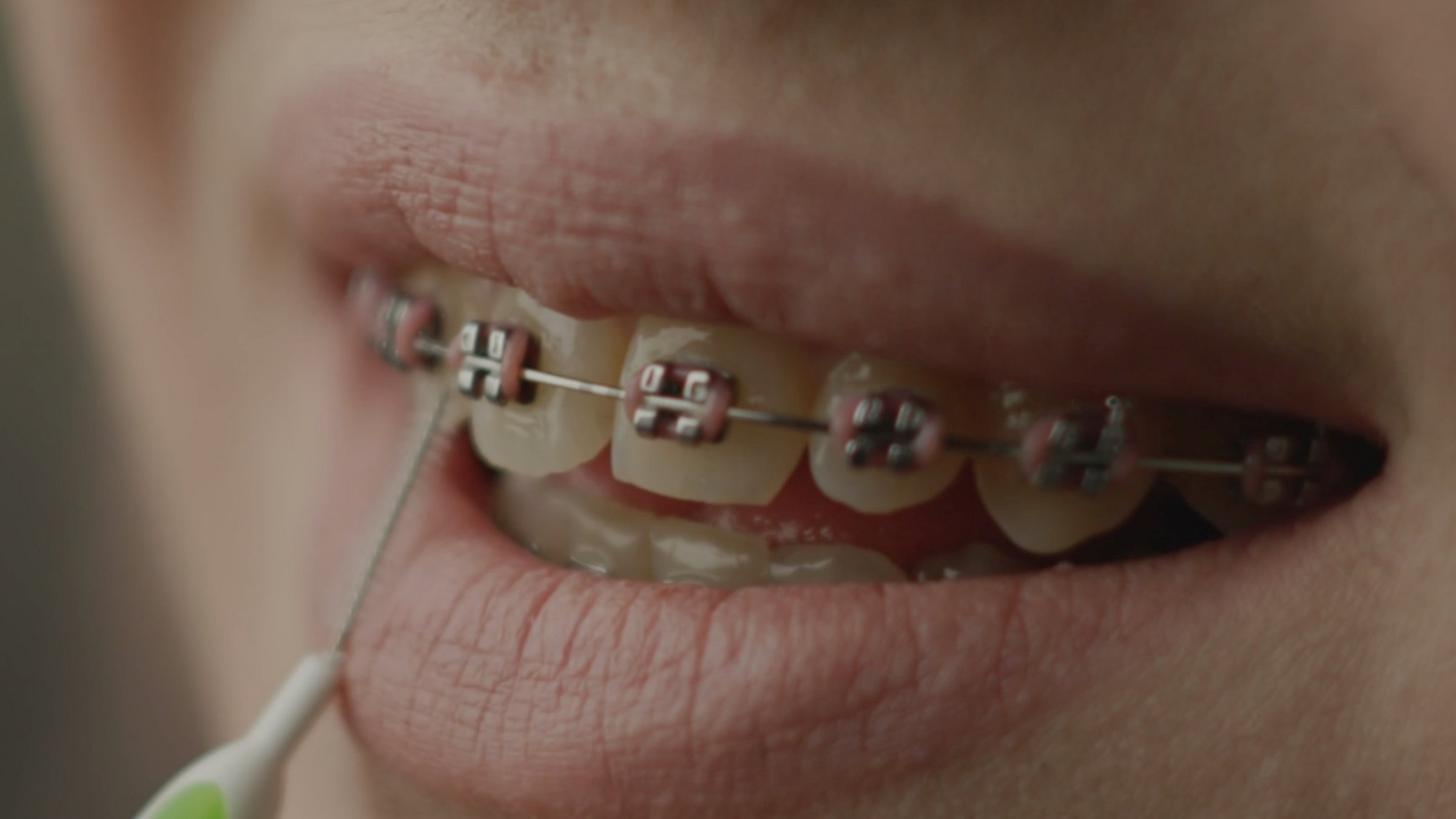 Wer sollte zum Kieferorthopäden?