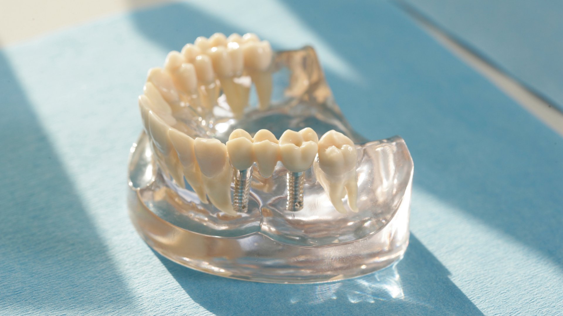 Knstliche Zahnwurzel mit Implantaten