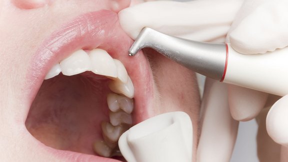Dentalhygienikerin reinigt Zähne mit Pulverstrahlgerät