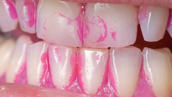 Karies sichtbar gemacht