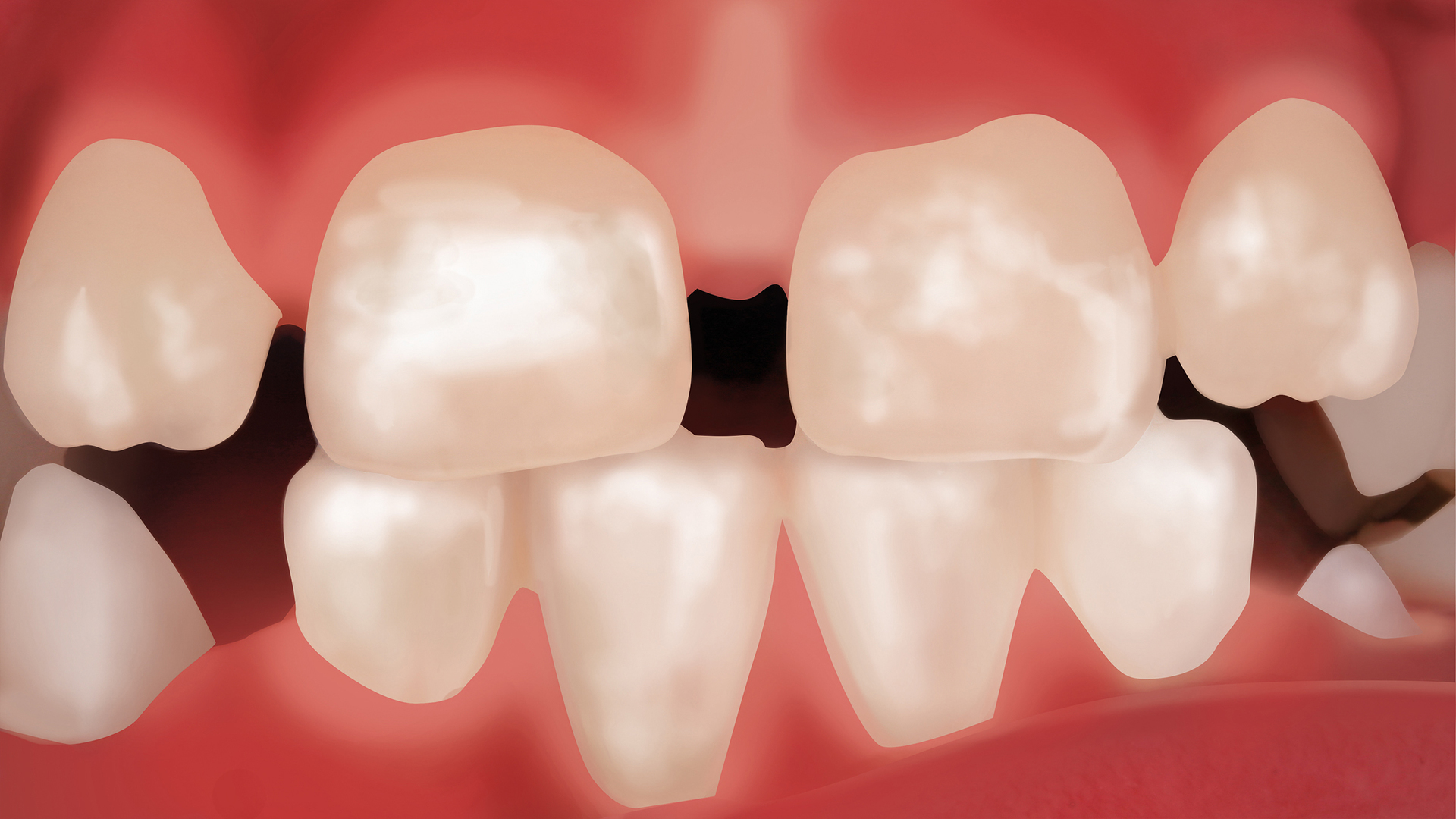 Grau sich zahn verfärbt Zahnunfall beim