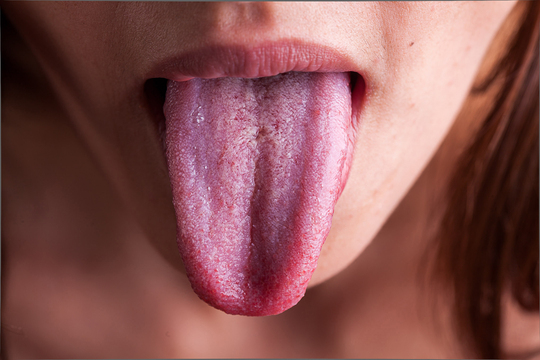 Zungenbelag grauer Belegte Zunge: